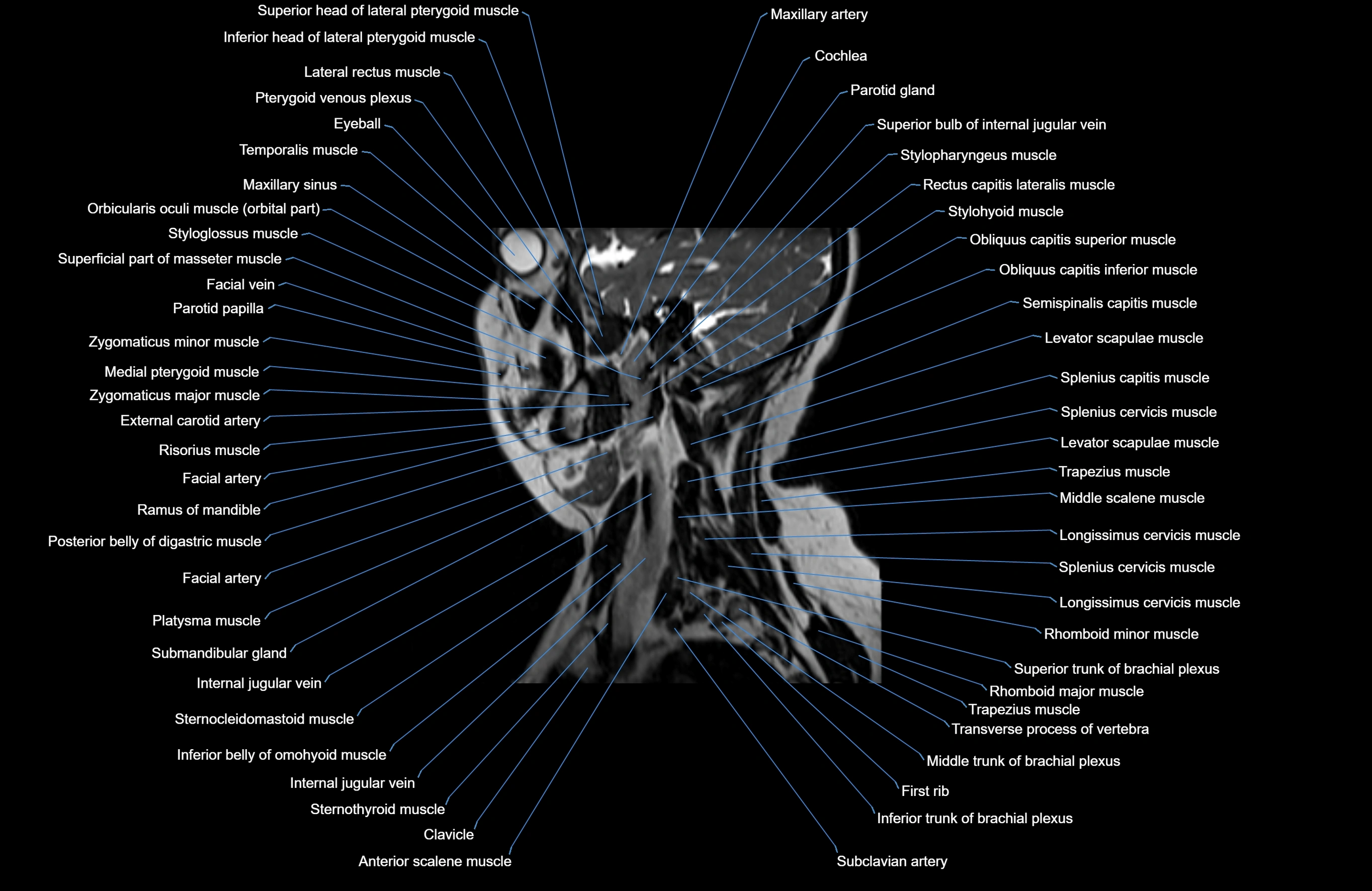 Neck MRI sagittal cross sectional anatomy 3D 1mm 3T radiology  image-img-00001-00023.webp